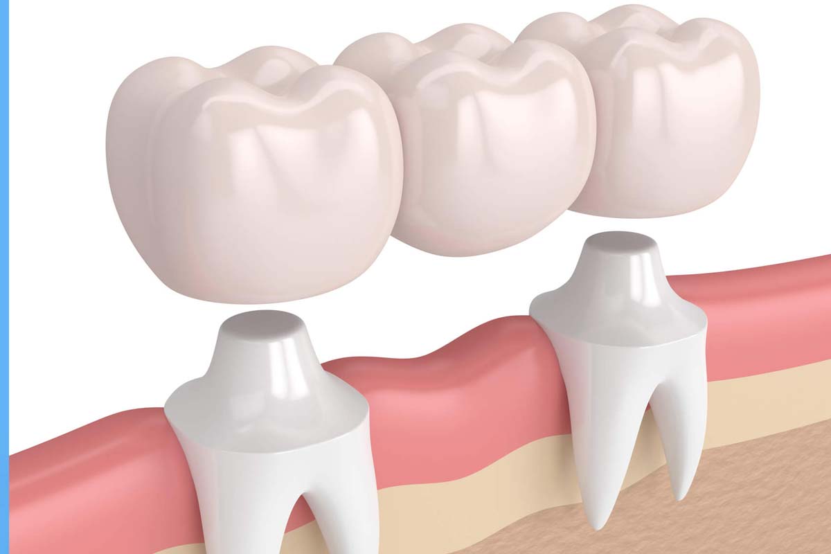 ایمپلنت بهتر است یا پروتز ثابت دندان