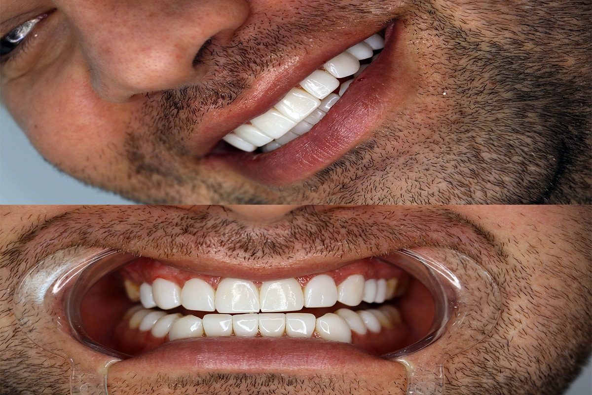 اصلاح نامرتبی دندان ها