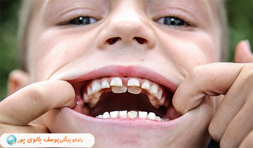 دندان کوسه ای در کودکان