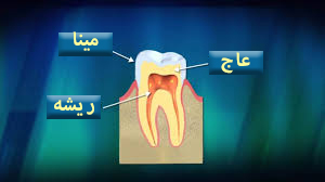رفع پوسیدگی دندان
