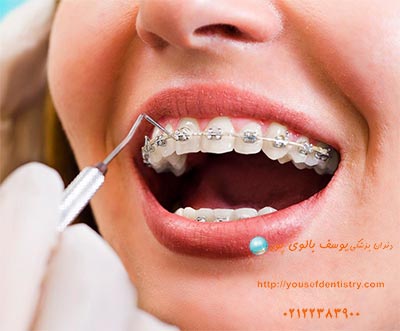 ارتودنسی دندان را در مطب دکتر یوسف بالوی پور تجربه کنید