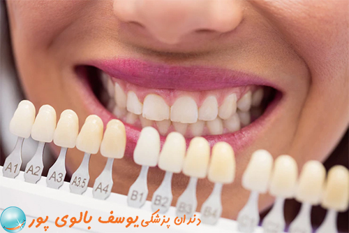 لمینت دندان در دندانپزشکی دکتر بالوی پور