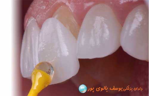 لمینت دندان در مطب دکتر یوسف بالوی پور
