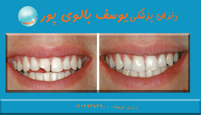 کامپوزیت دندان در مطب دکتر بالوی پور