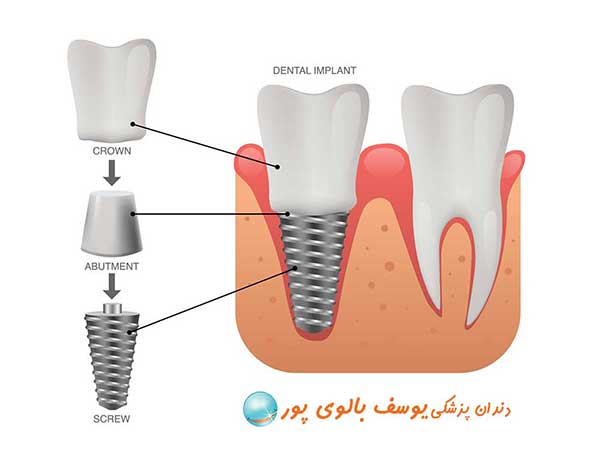 ایمپلنت دندان در دندانپزشکی بالوی پور