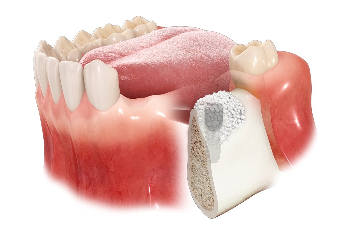 پیوند استخوان برای ایمپلنت دندان