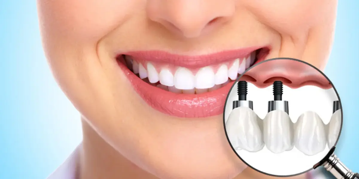 Dental_implant.webp