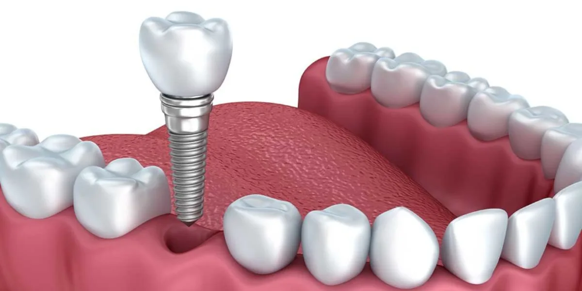 Dos_and_Donts_After_Dental_Implants.webp