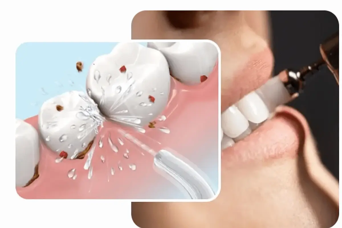 جرم دندان چیست و چگونه شکل می‌گیرد؟