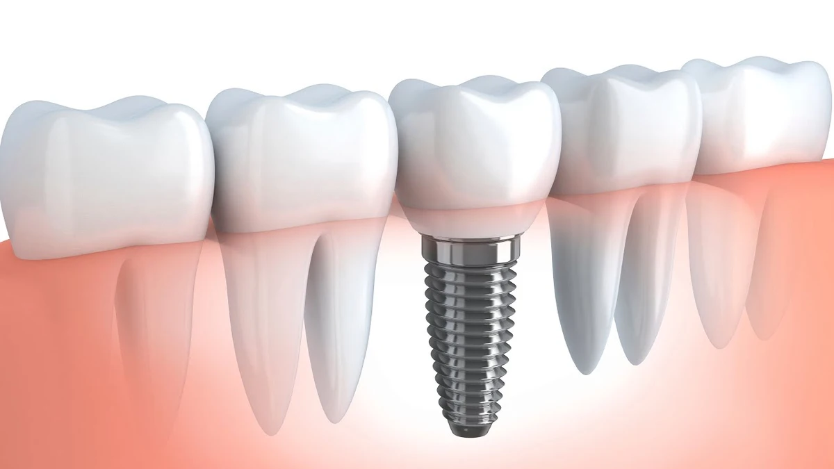 Post-dental_implant_care.webp