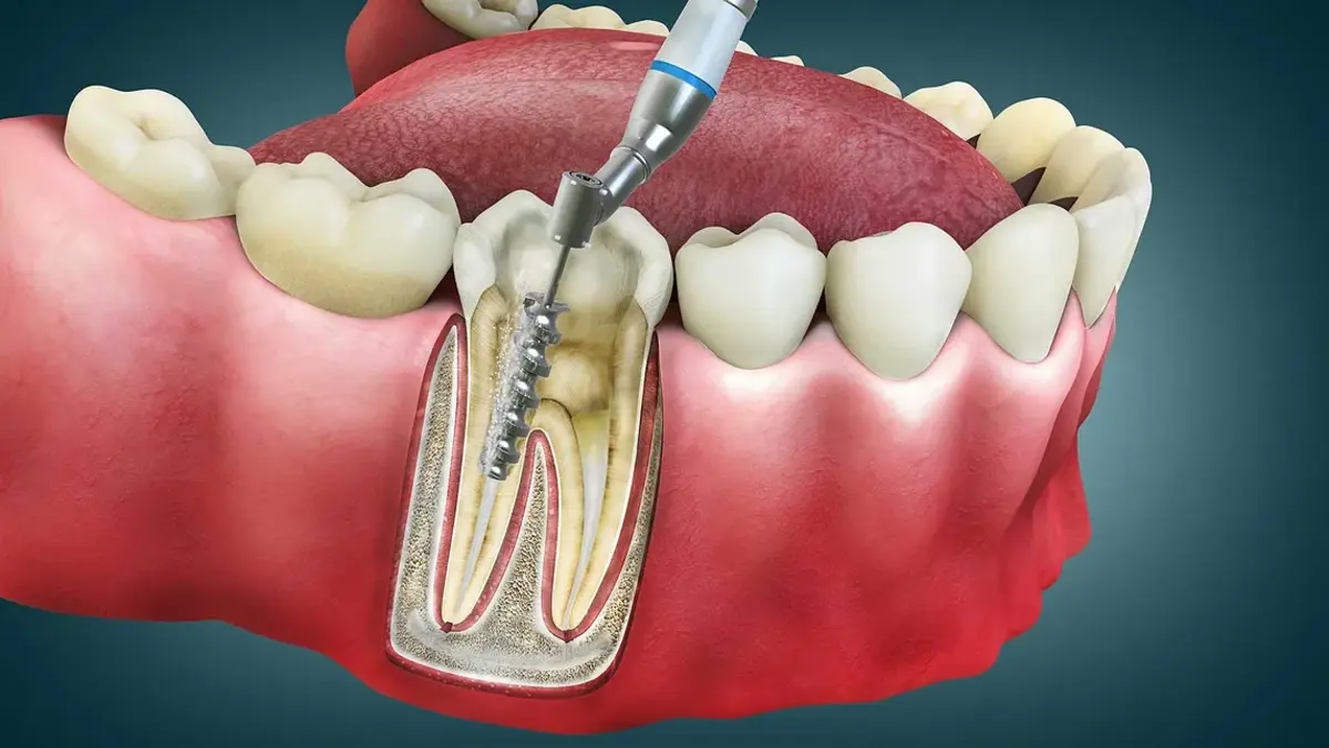 Root_canal_treatment_teeth.webp