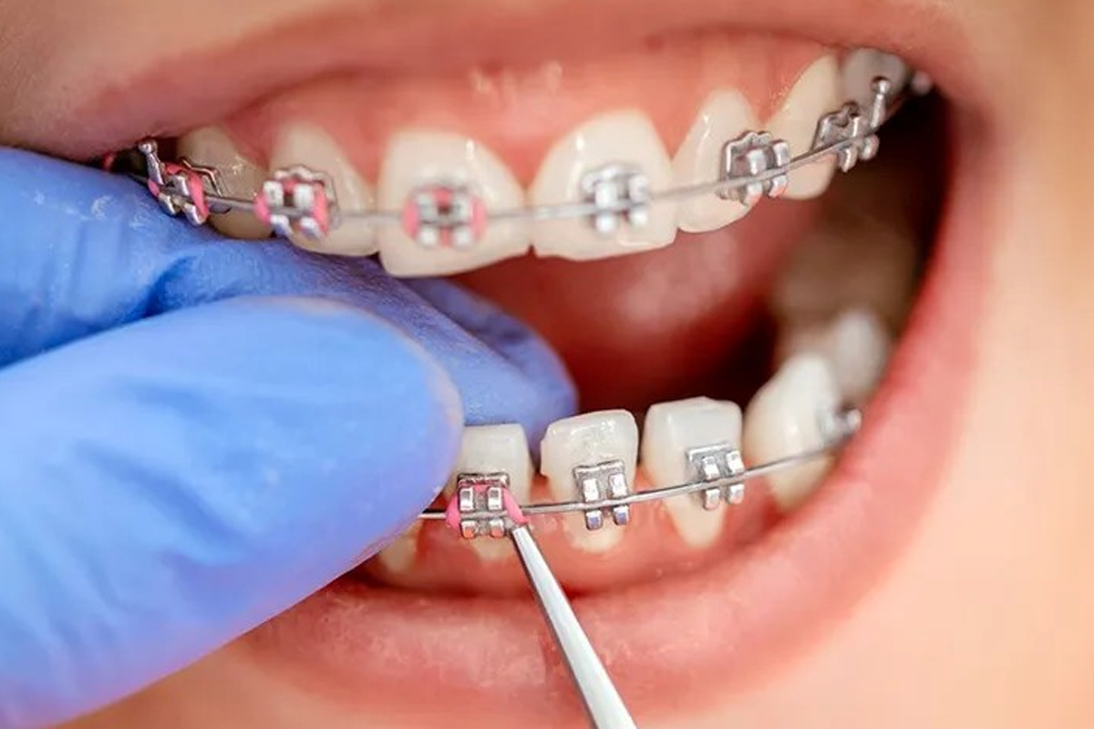 مراقبت های قبل از ارتودنسی دندان
