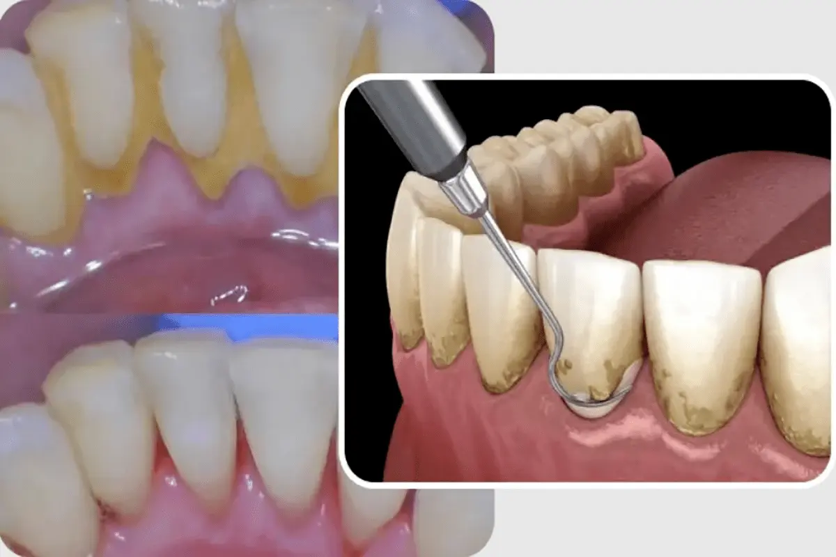 چگونه جرم‌ گیری دندان سلامت بدن را تضمین می‌ کند؟