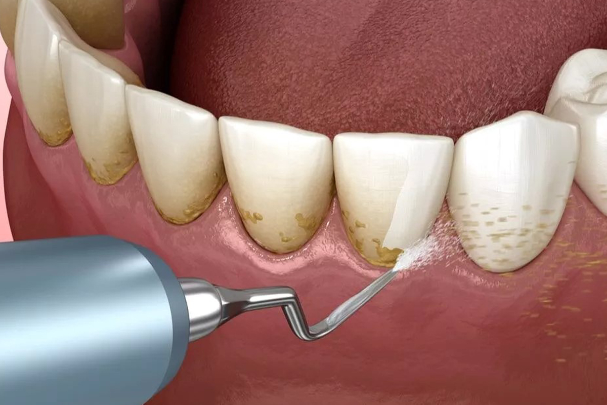 نتایج جرمگیری دندان و بلیچینگ