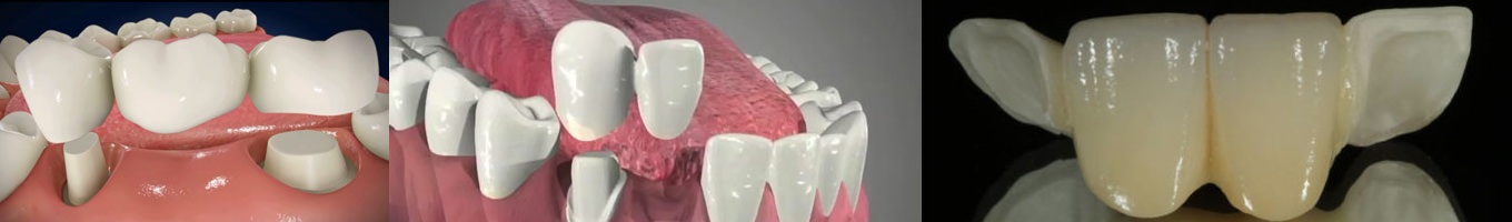 پل دندان چیست