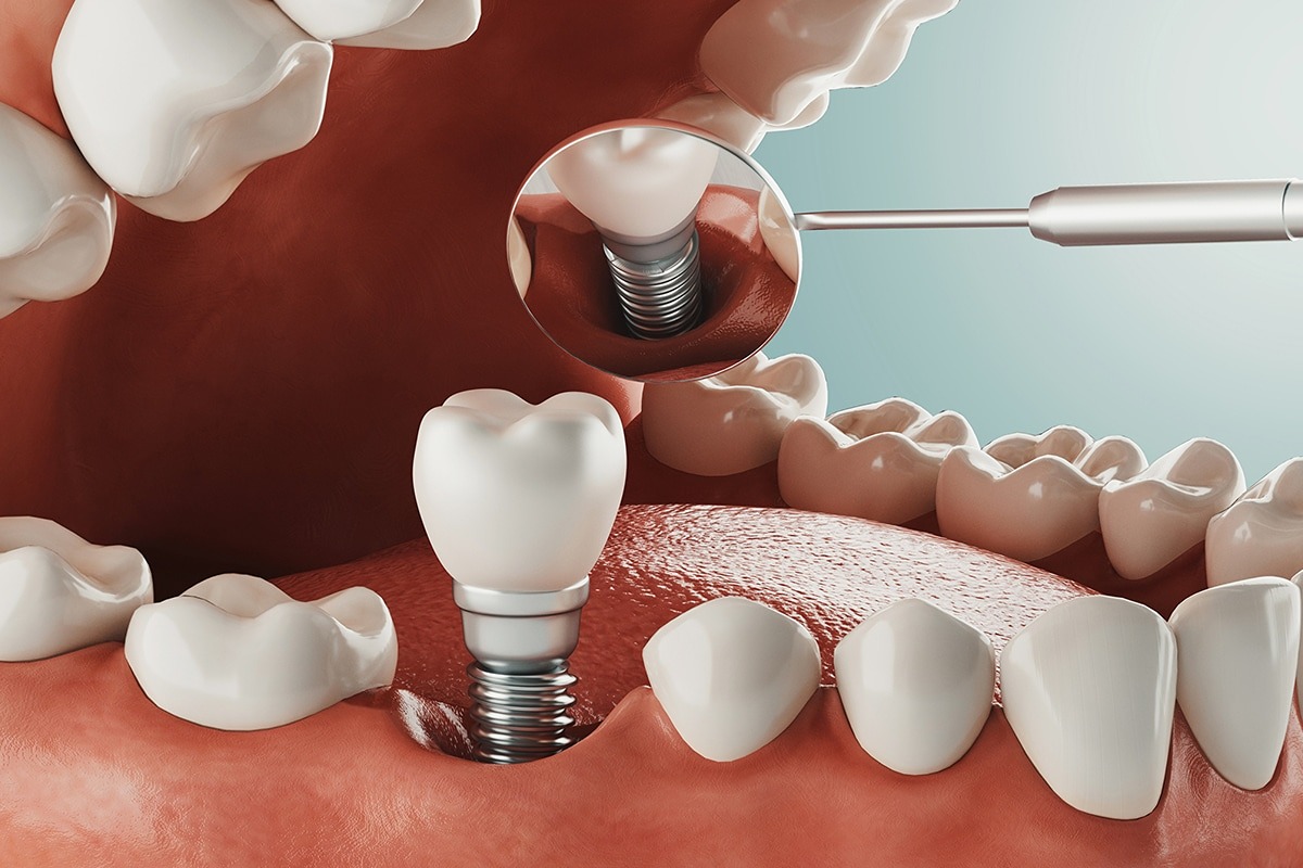 مزایای شگفت ‌انگیز ایمپلنت دندان بدون جراحی