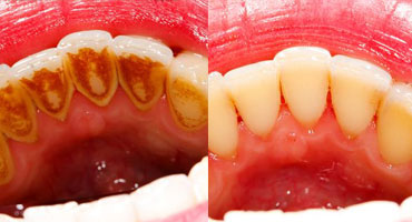 جرم گیری دندان یا بروساژ