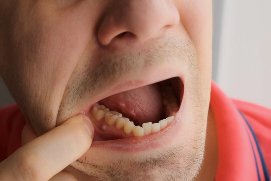 tooth_abscess.jpg